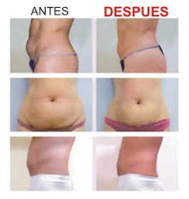 TRATAMIENTOS REDUCTORES